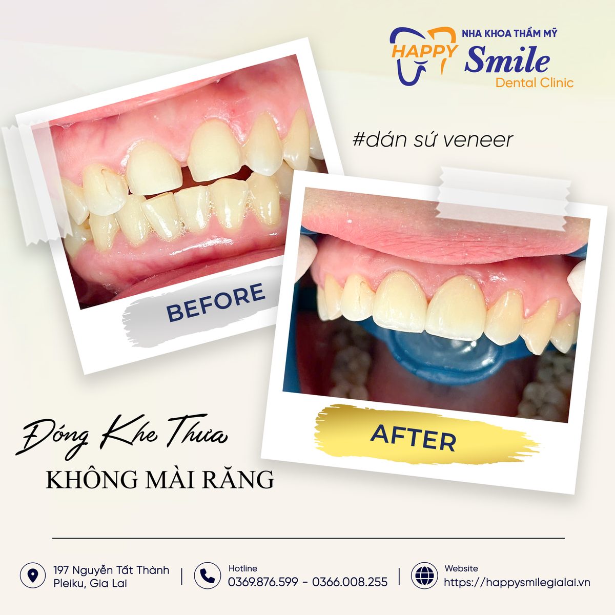 Dán sứ Veneer đóng khe thưa