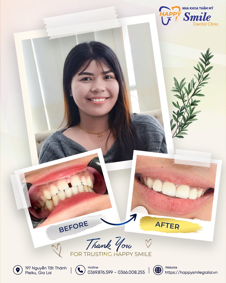 Khách hàng PH Vơn: Răng toàn sứ Zirconia