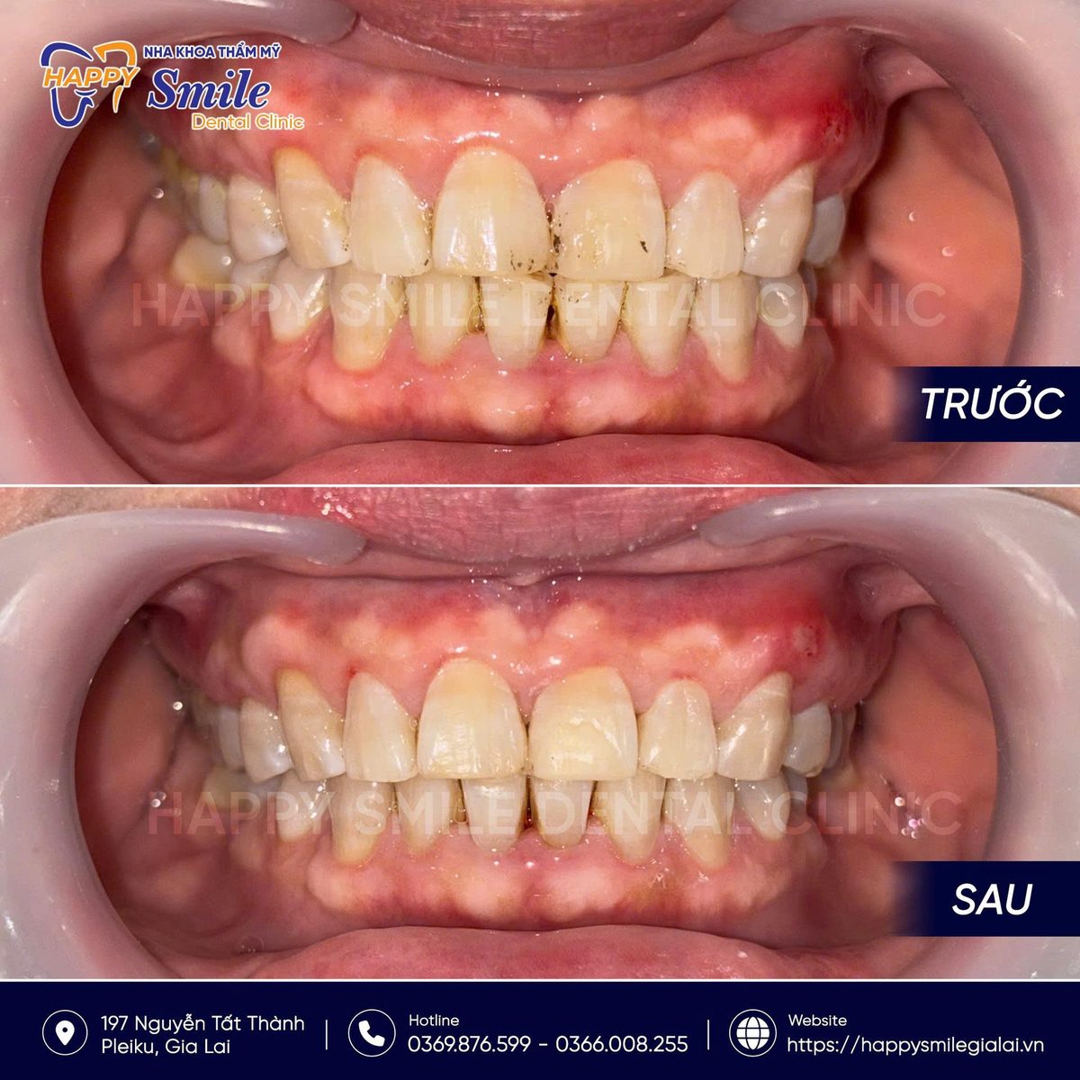 KH Nguyễn Thị Mai Hoa: Cạo Vôi răng