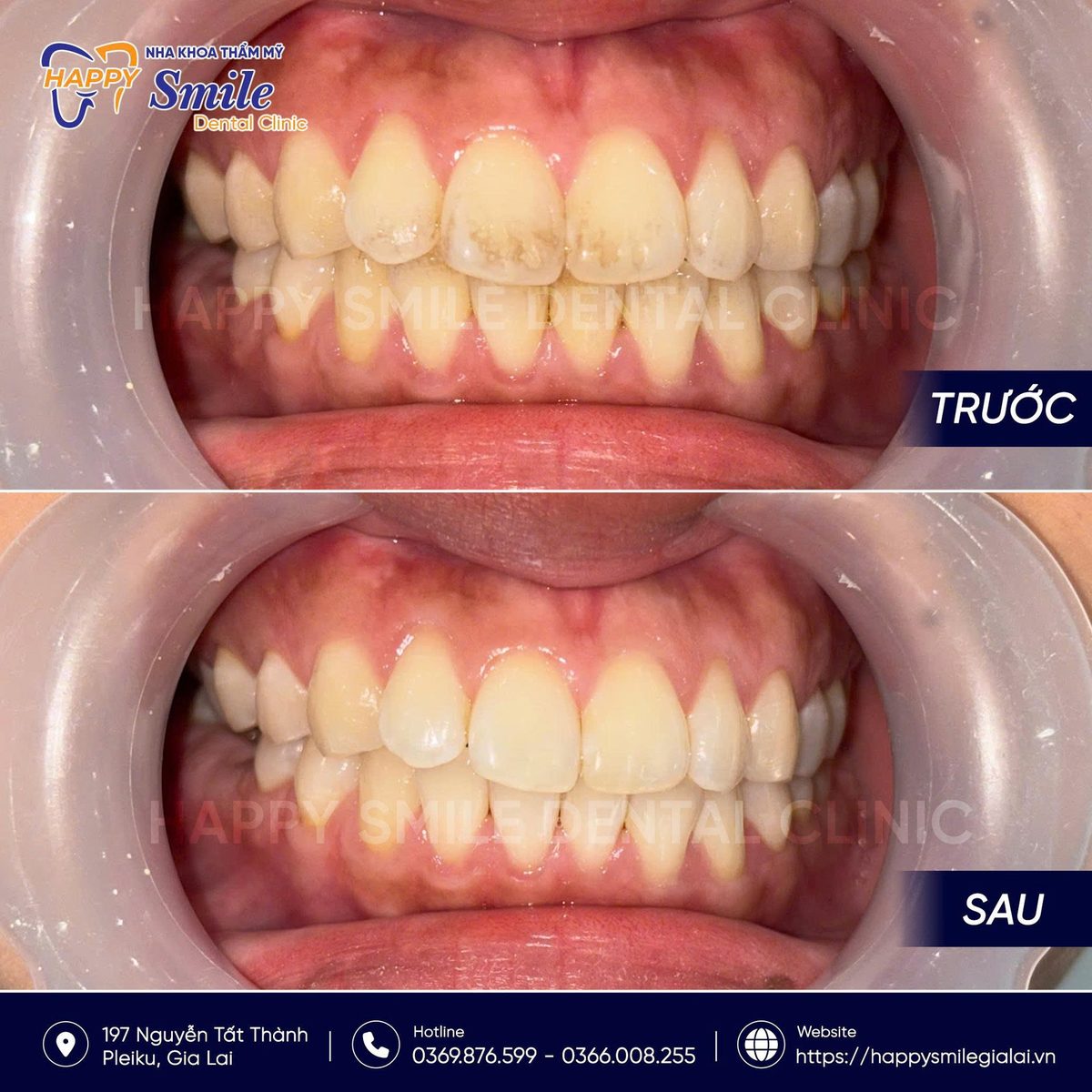 KH Huỳnh Thị Như Thảo: Cạo Vôi Răng