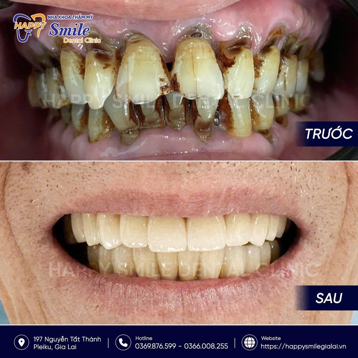 KH Nguyễn Thanh Quang: Răng sứ thẩm mỹ