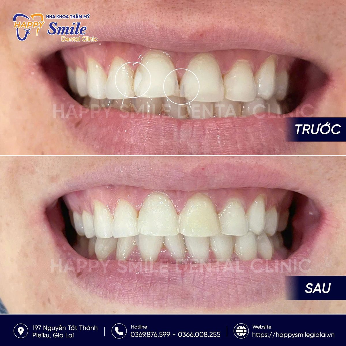 KH Đinh Thị Tú Trinh: Trám răng thẩm mỹ