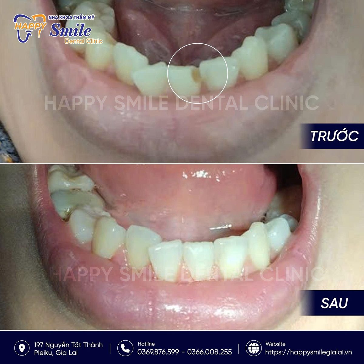 KH Phan Thị Mỹ Na: Trám răng thẩm mỹ