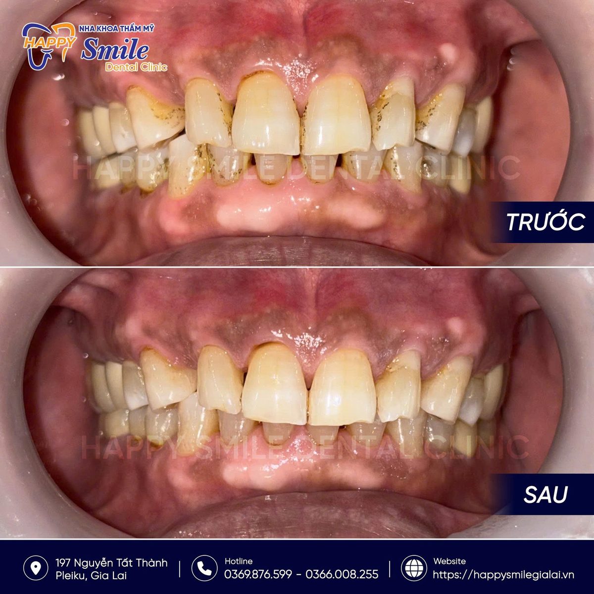 KH Hồ Ngọc: Cạo Vôi Răng