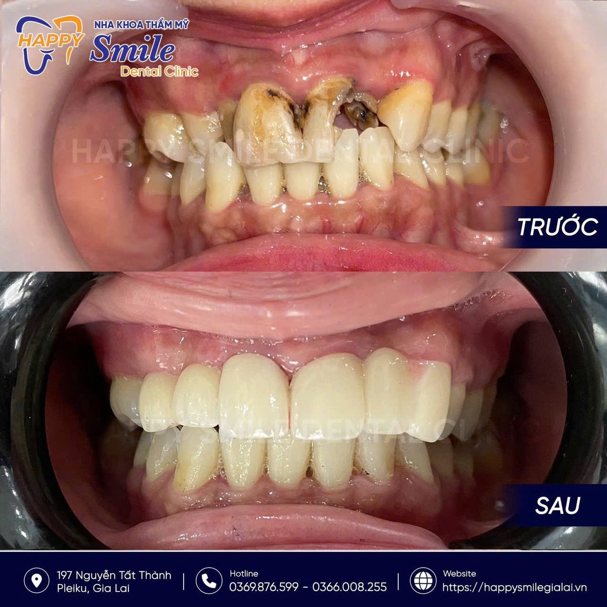 KH Tô Thiên Trang: Phục hình răng sứ