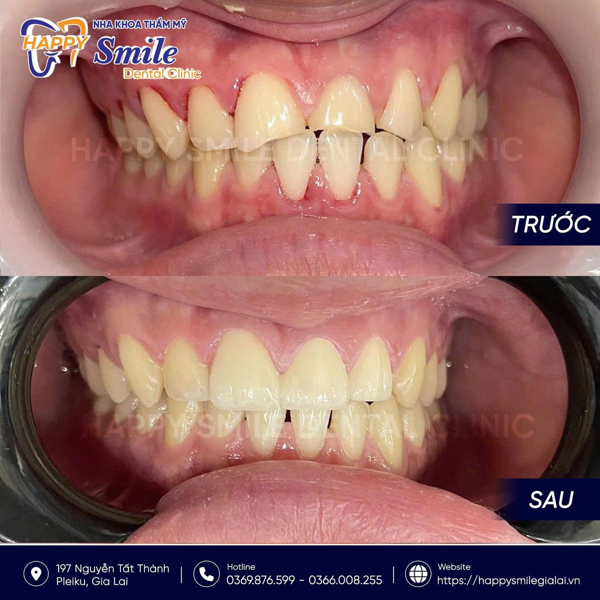 KH Lường Gia Bảo: Phục hình thẩm mỹ răng cửa