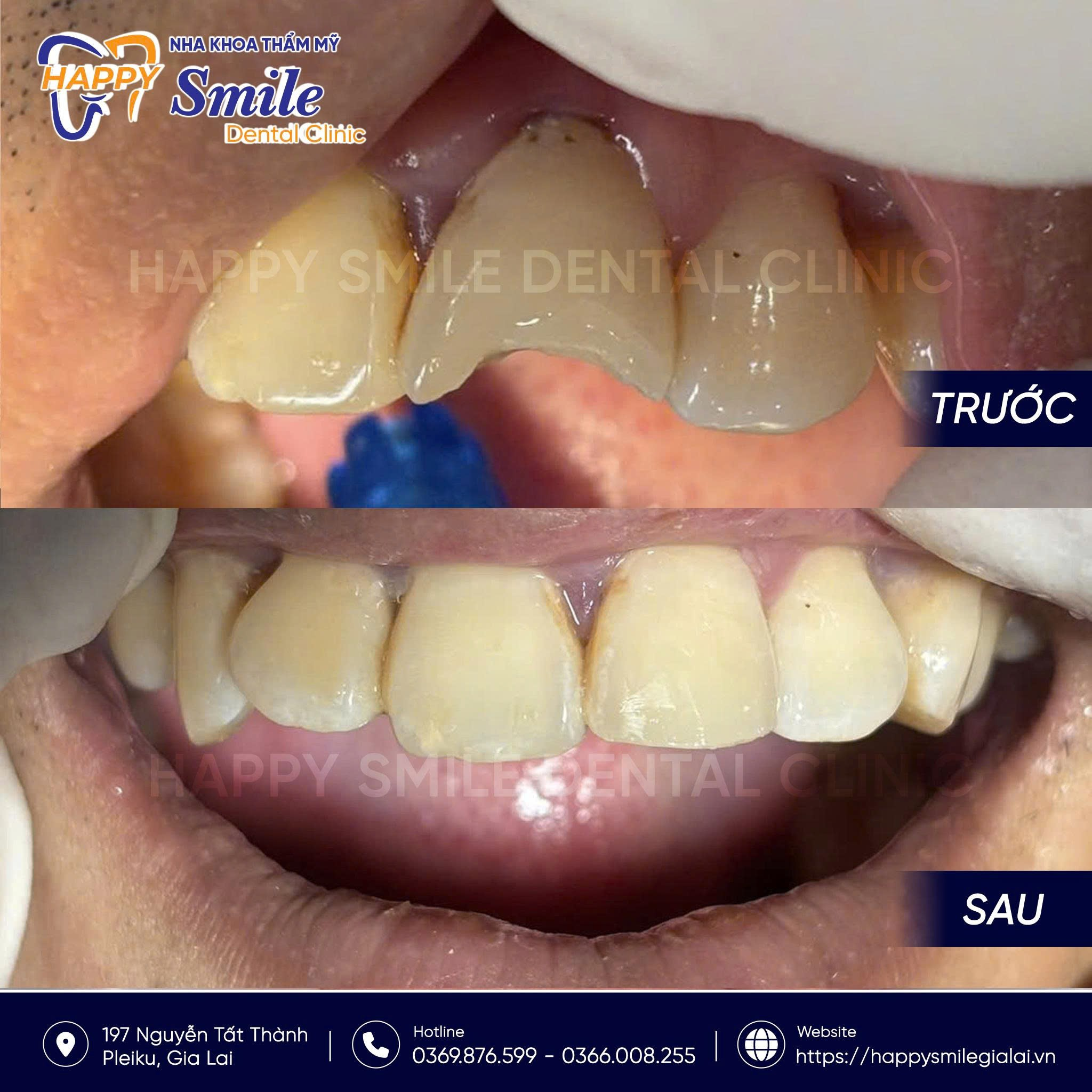 KH Nguyễn Văn Vũ: Trám răng cửa thẩm mỹ