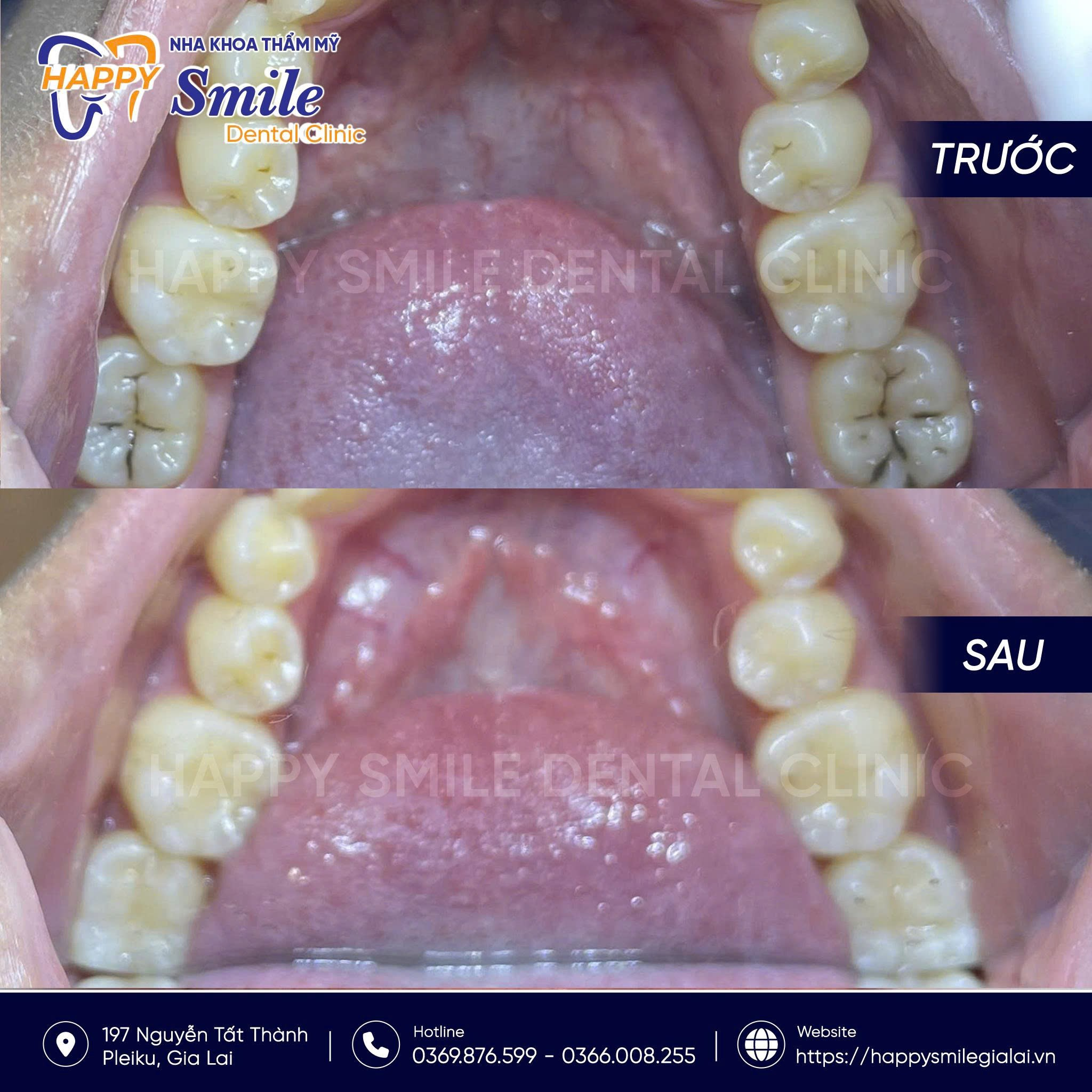 KH Trần Thị Thùy Dinh: Trám răng