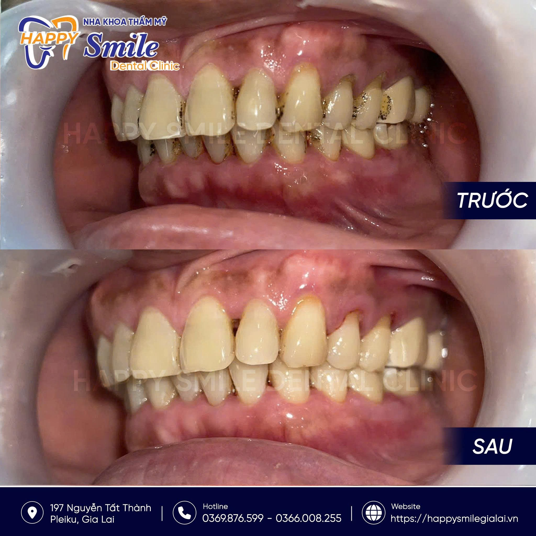 KH Nguyễn Phước Vương: Lấy vôi răng