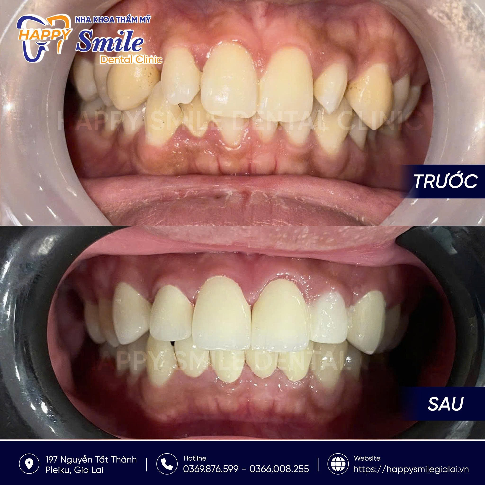 KH Minh Sơn: Răng sứ Zirconia
