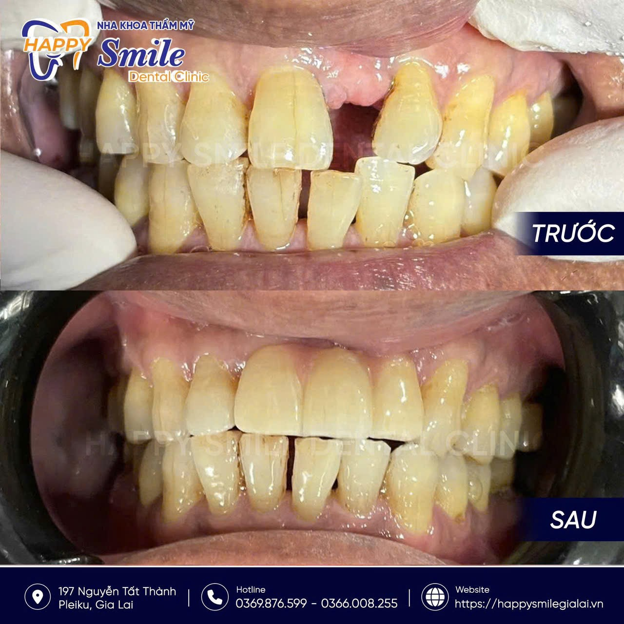 KH Hồ Xuân Hòa: Phục hình sứ thẩm mỹ