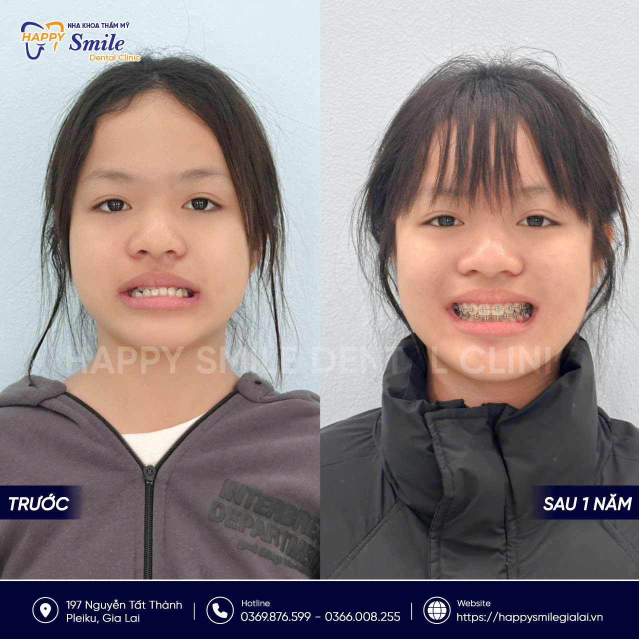 KH Mùi Nguyễn Ngọc Anh: Niềng răng mắc cài