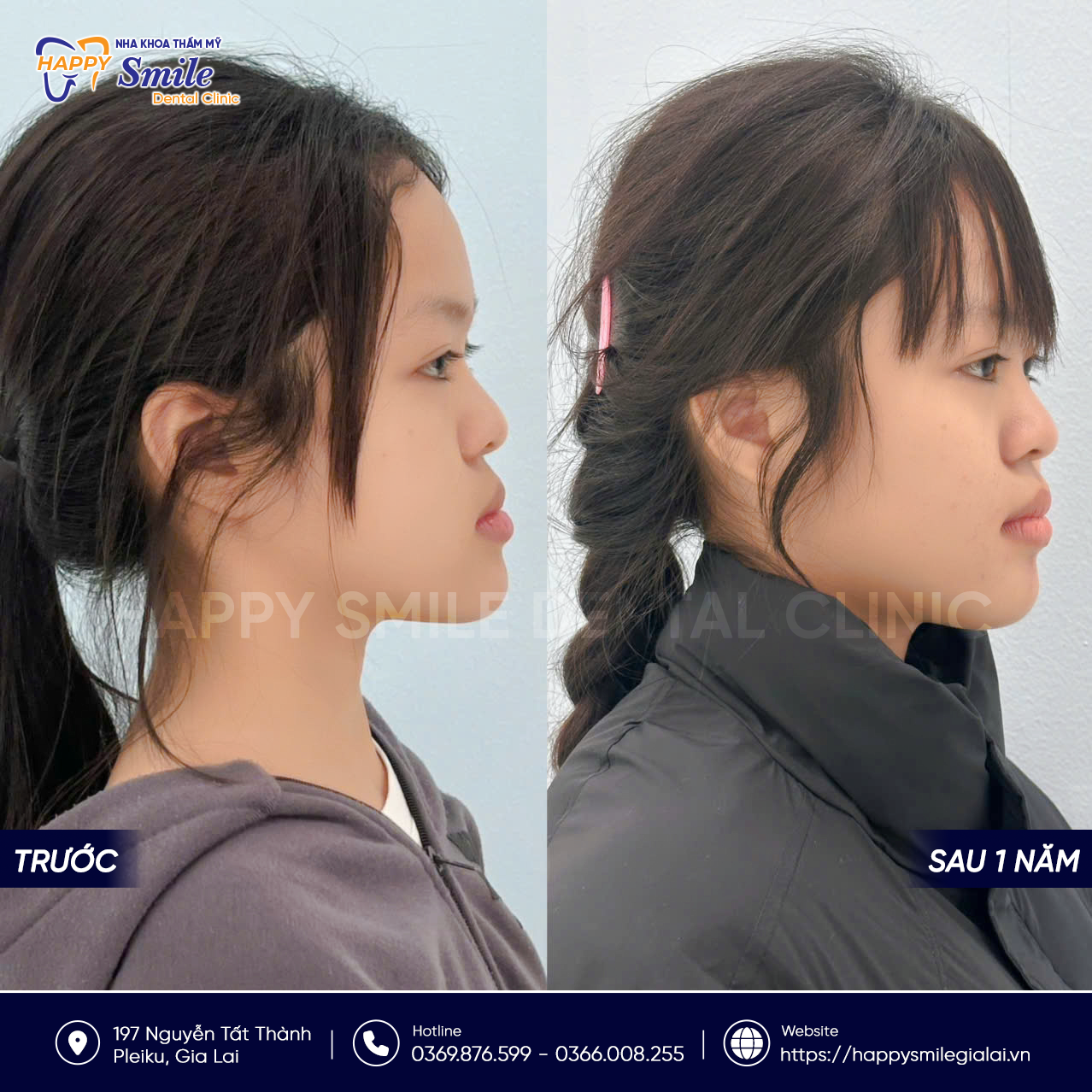 KH Mùi Nguyễn Ngọc Anh: Niềng răng mắc cài