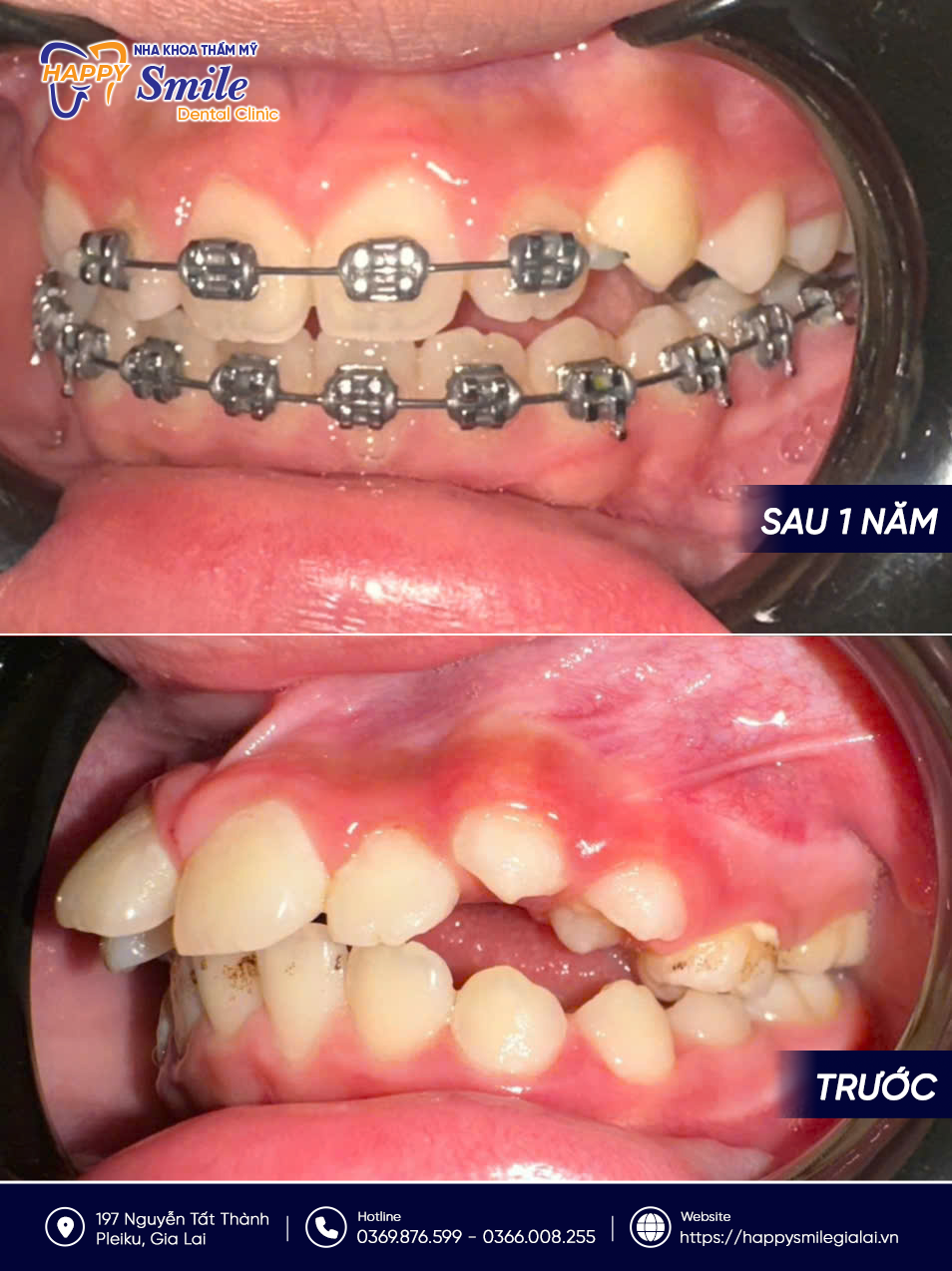 KH Trần Ngọc Bảo Trâm: Niềng răng mắc cài