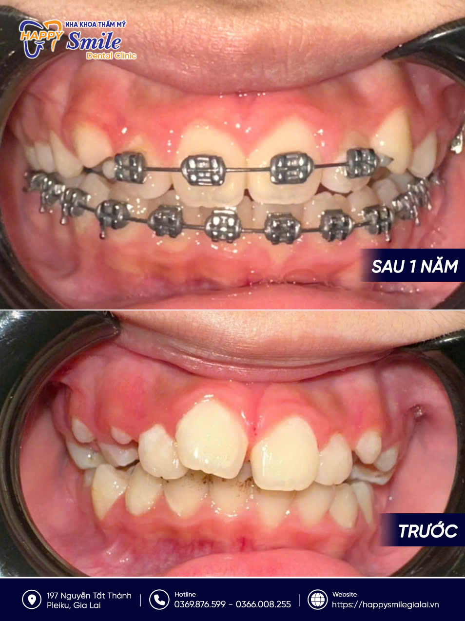 KH Trần Ngọc Bảo Trâm: Niềng răng mắc cài