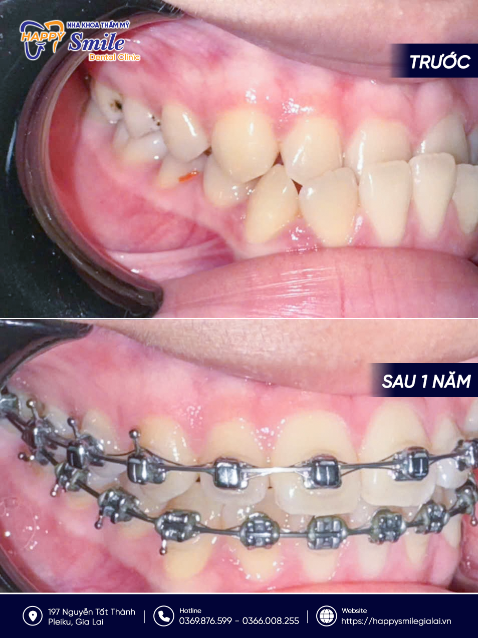 KH Hồ Thị Tuyết Mai: Niềng răng mắc cài