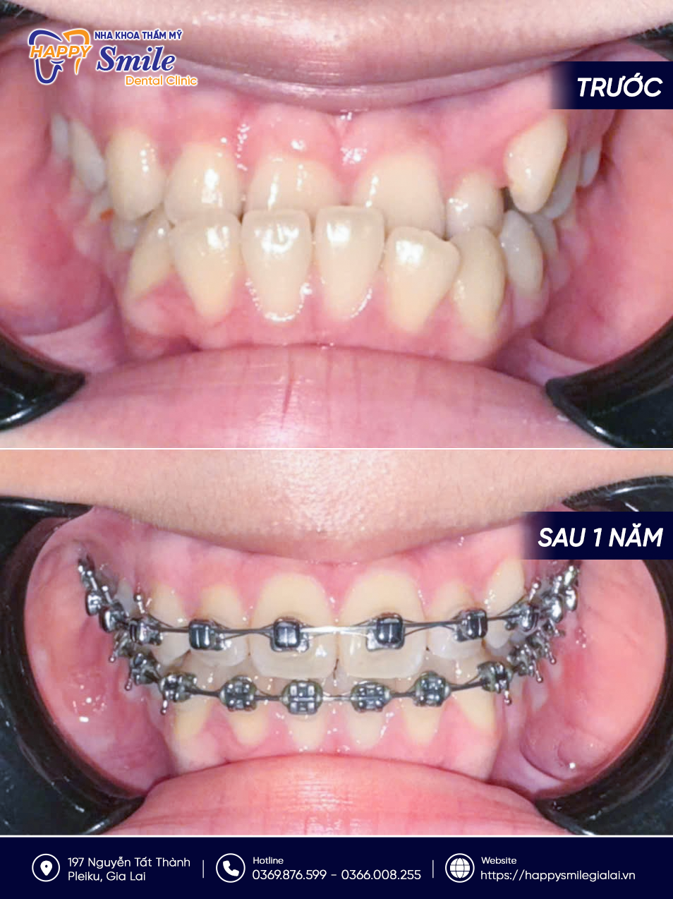 KH Hồ Thị Tuyết Mai: Niềng răng mắc cài