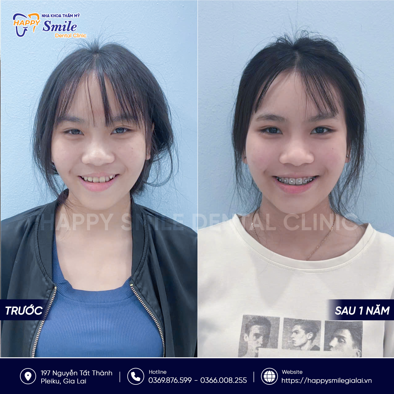KH Hồ Thị Tuyết Mai: Niềng răng mắc cài