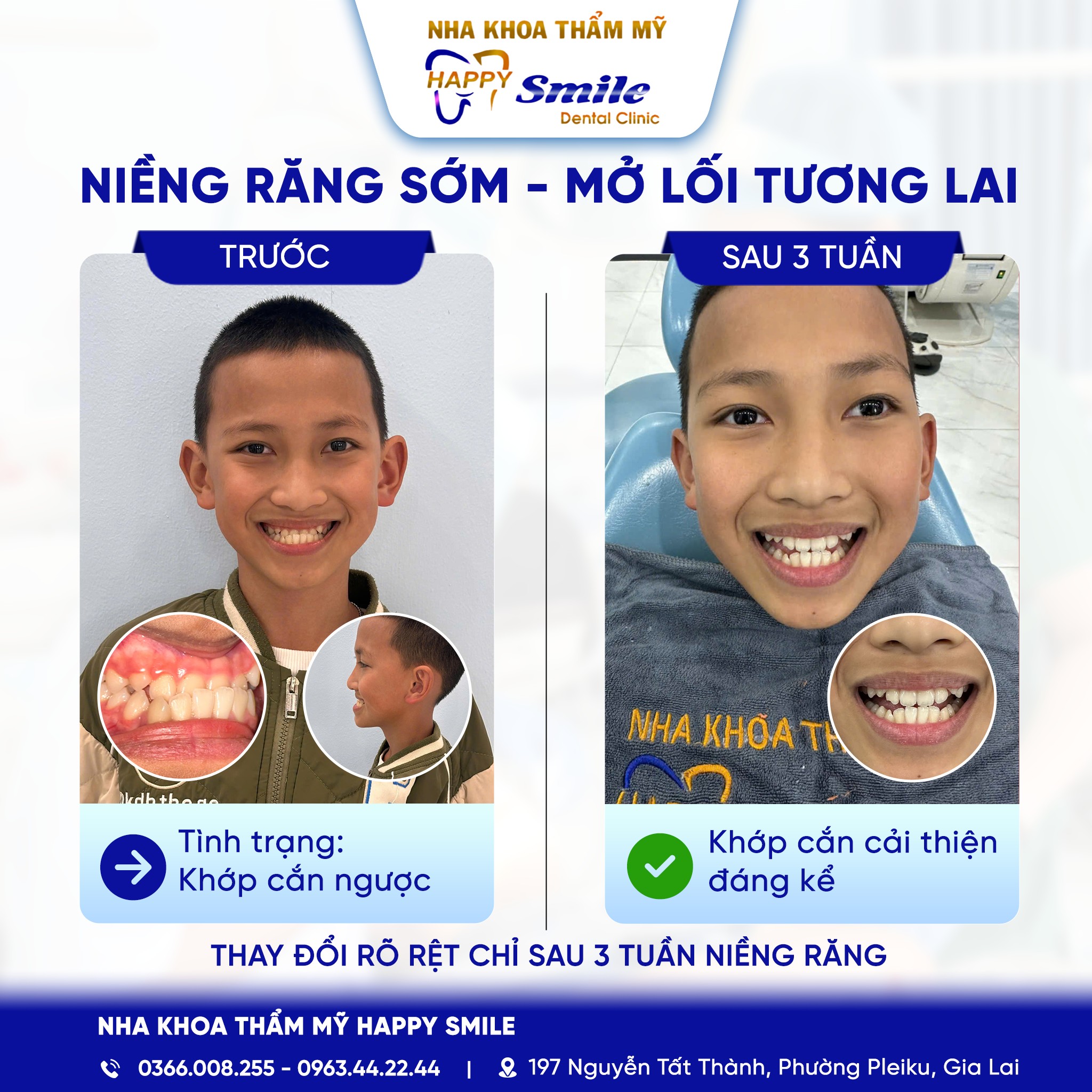 Cải thiện khớp cắn ngược chỉ sau 3 tuần niềng răng