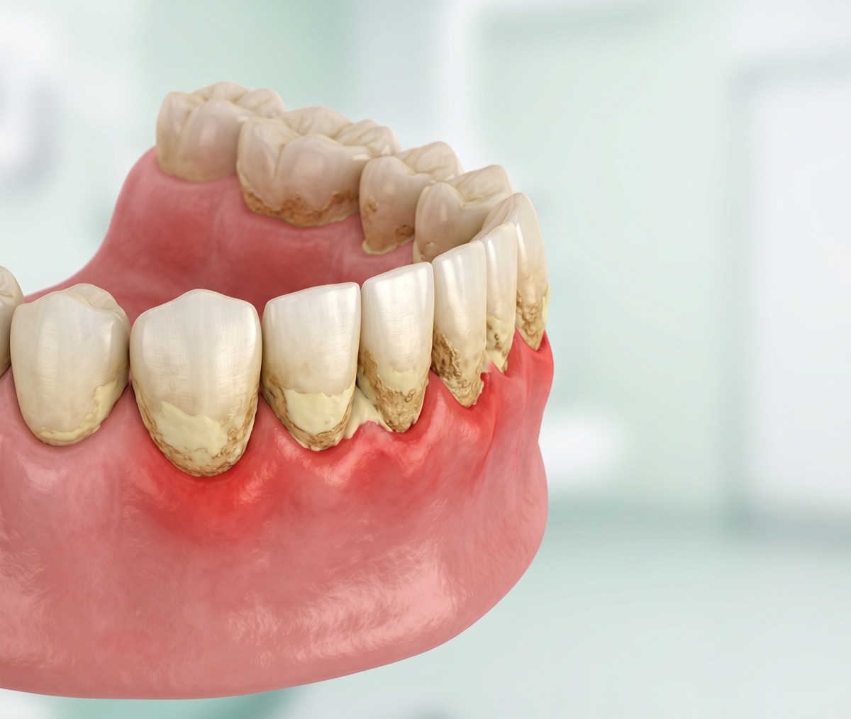 Cao răng t&iacute;ch tụ l&acirc;u ng&agrave;y g&acirc;y vi&ecirc;m nướu, h&ocirc;i miệng v&agrave; mất răng.